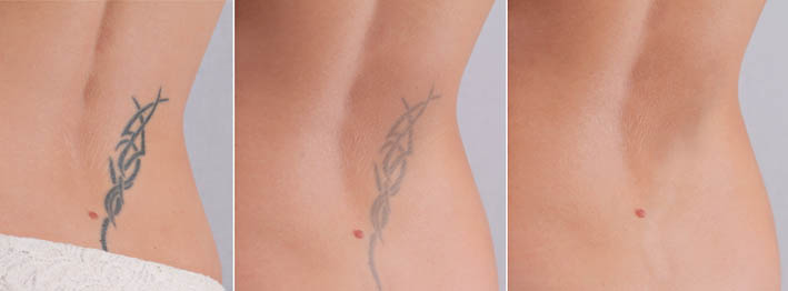 //rejuvi.es/wp-content/uploads/2018/01/laser-tattoo-removal-before-and-after.jpg